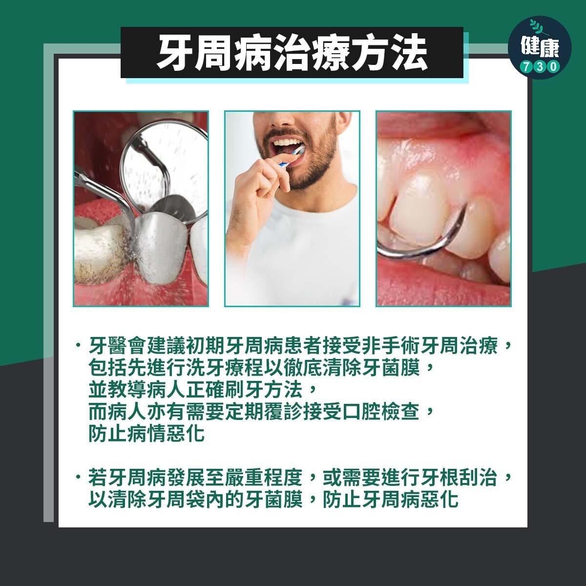 牙周病原因、影響及治療方法|洗牙療程(am730製圖)
