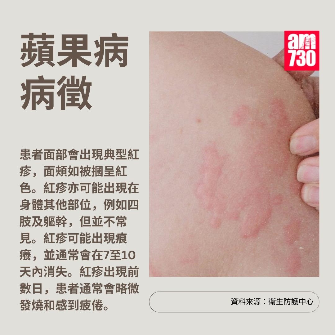 蘋果病|病徵(am730製圖)