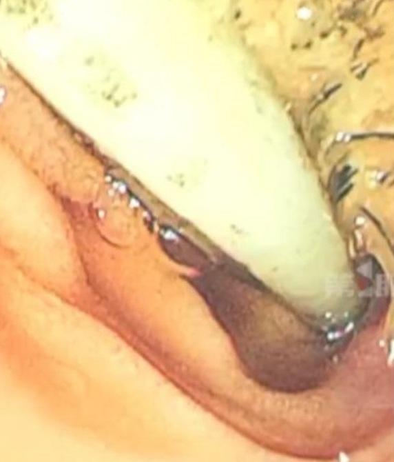 經胃鏡等檢查,牙刷藏在病人十二指腸球部彎曲處。(互聯網)