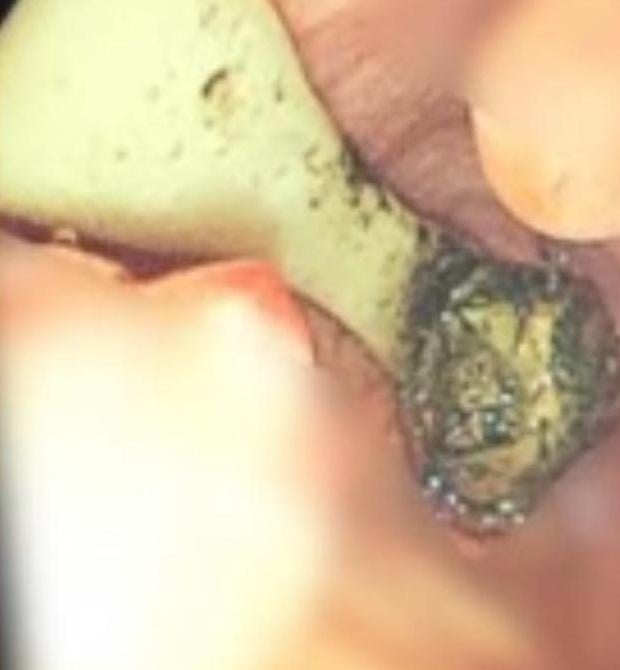 經胃鏡等檢查,牙刷藏在病人十二指腸球部彎曲處。(互聯網)