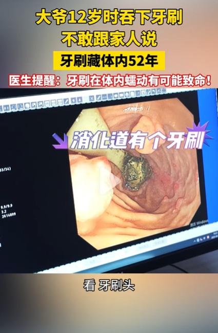 醫生檢查後發現,一支陳年牙刷藏在病人體內。(互聯網)