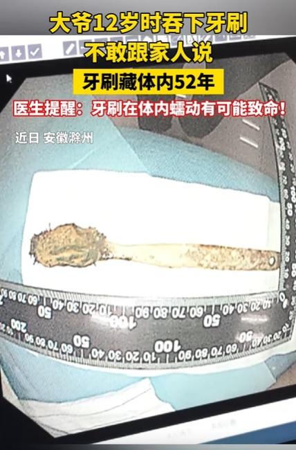 醫生動手術,替楊姓男子取出52年前的兒童牙刷。(互聯網)