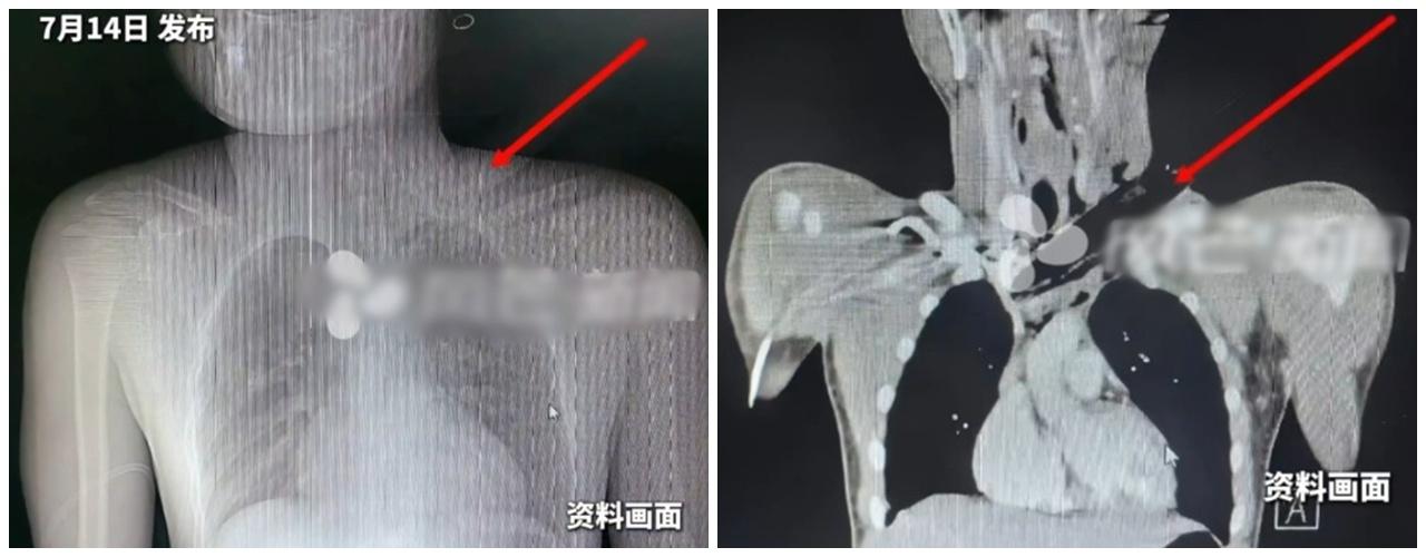 影像學檢查顯示,任何一處血管破裂都將導致傷者瞬間致命。(微博)