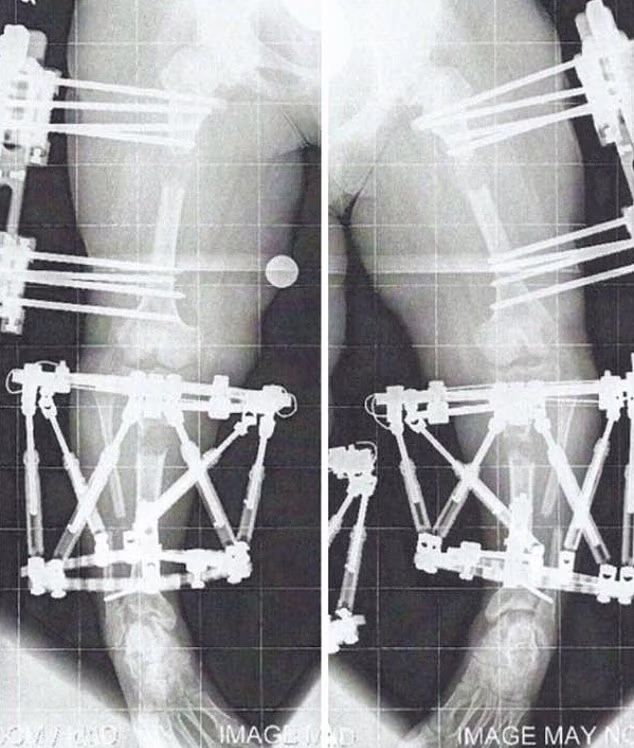 克魯斯接受手術。(互聯網)