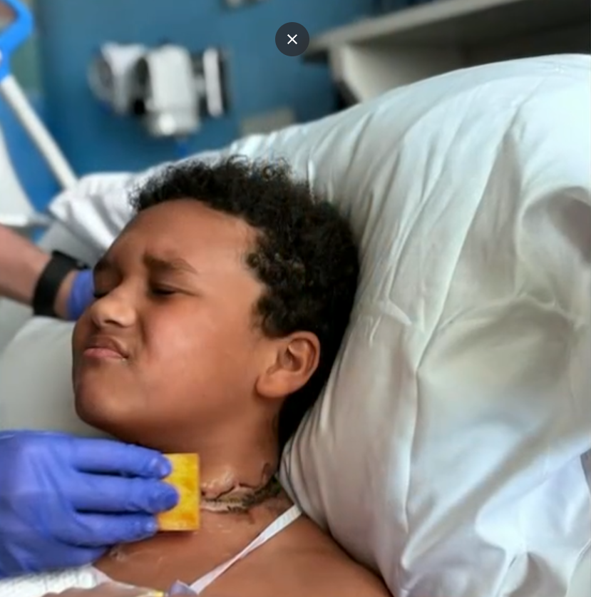 頸鍊纏住平板充電線起火 睡夢中驚醒男童頸燒燶