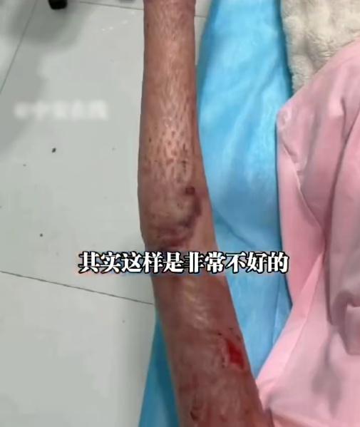 女子臉部及身體多處遭受嚴重的二至三度燒燙傷。(微博)