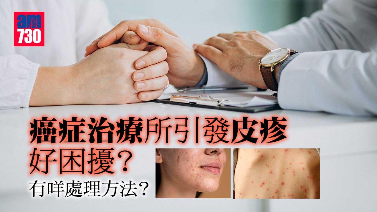 癌症治療所引發皮疹好困擾？有咩處理方法？