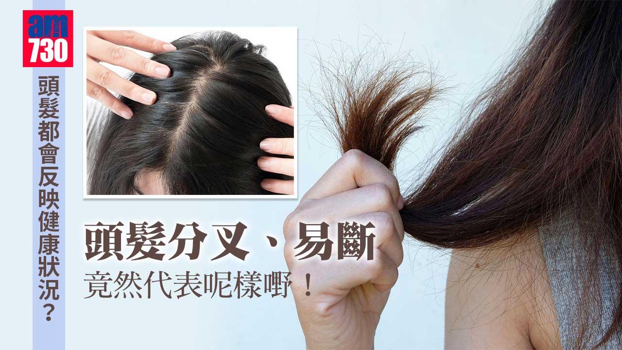 頭髮｜反映健康狀況？ 