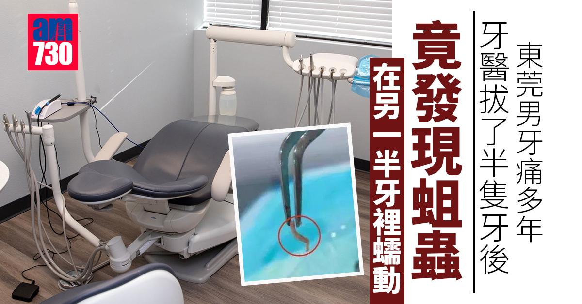 莞男牙痛多年 牙醫拔出一條活蛆蟲