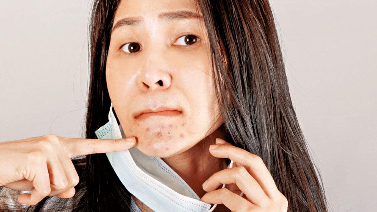 疫下長戴口罩 留意暗瘡問題