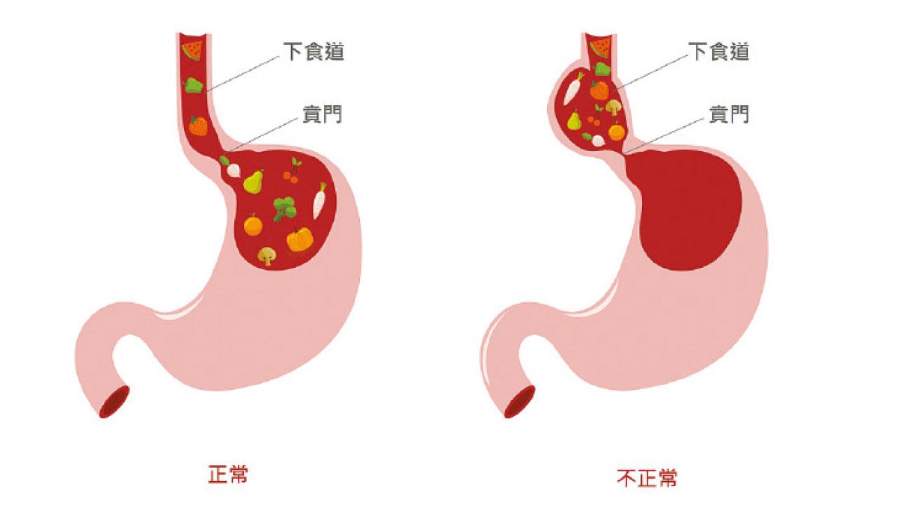 食管動力障礙 賁門失弛緩症
