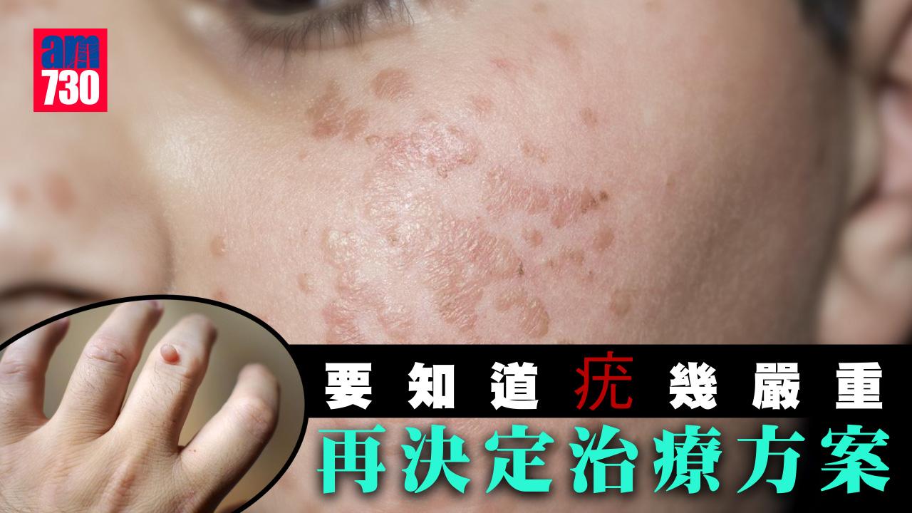 消委會｜要知道「疣」幾嚴重