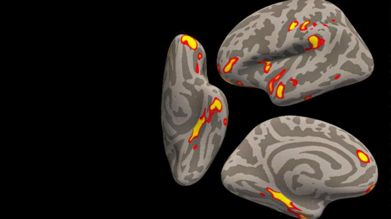 新冠病毒或致腦縮小