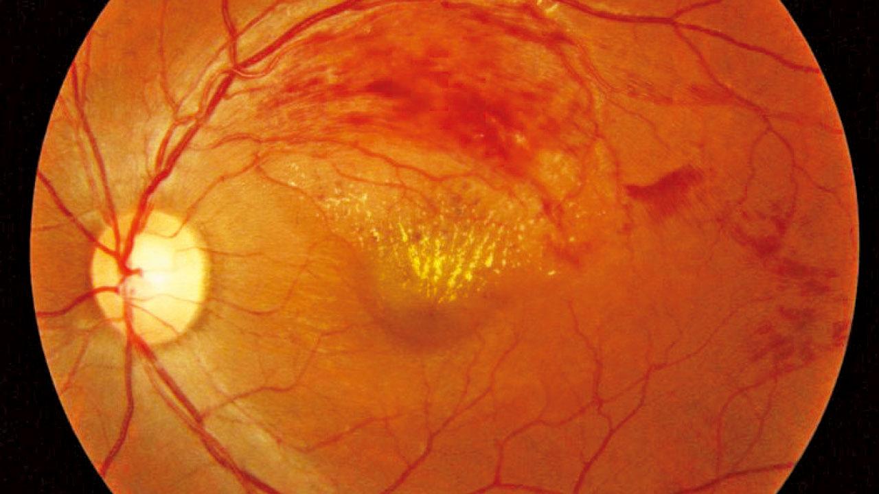 三高與視網膜血管疾病(二)