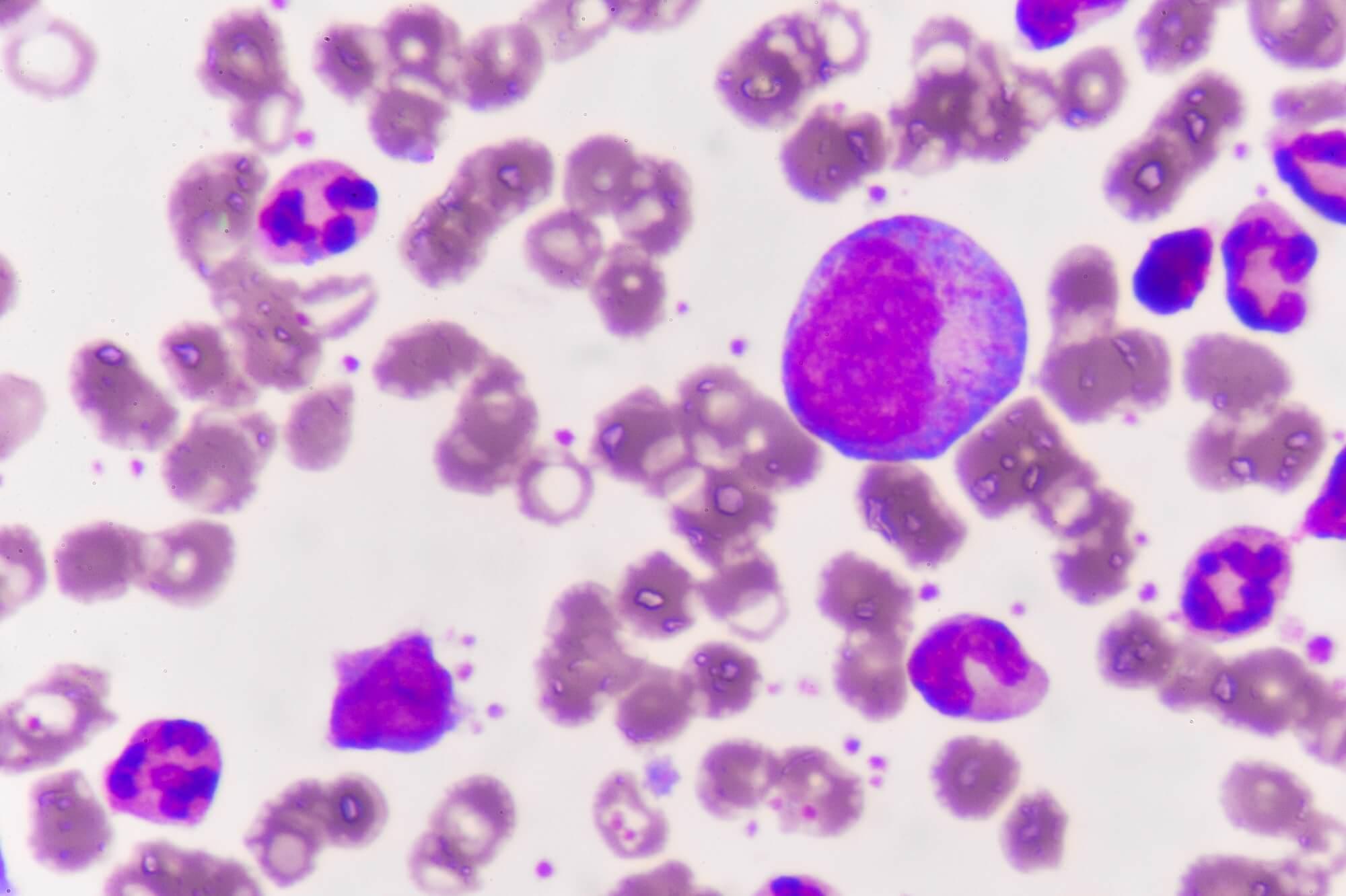 慢性淋巴細胞白血病