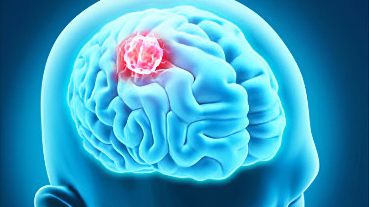 腦腫瘤