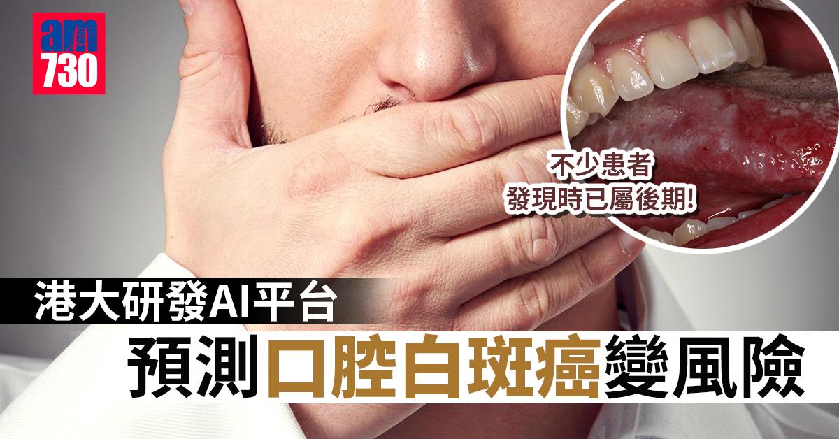 港大研發AI平台 預測口腔白斑癌變風險