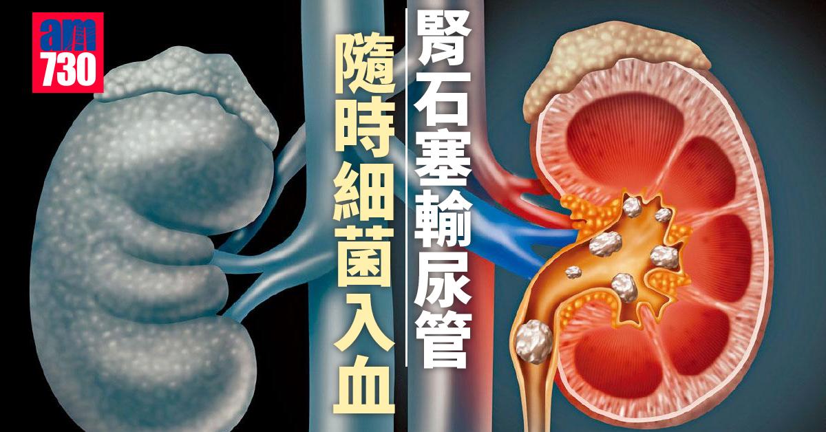 腎石塞輸尿管 隨時細菌入血