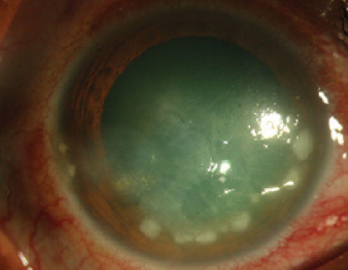 隱形眼鏡導致的角膜感染可致盲