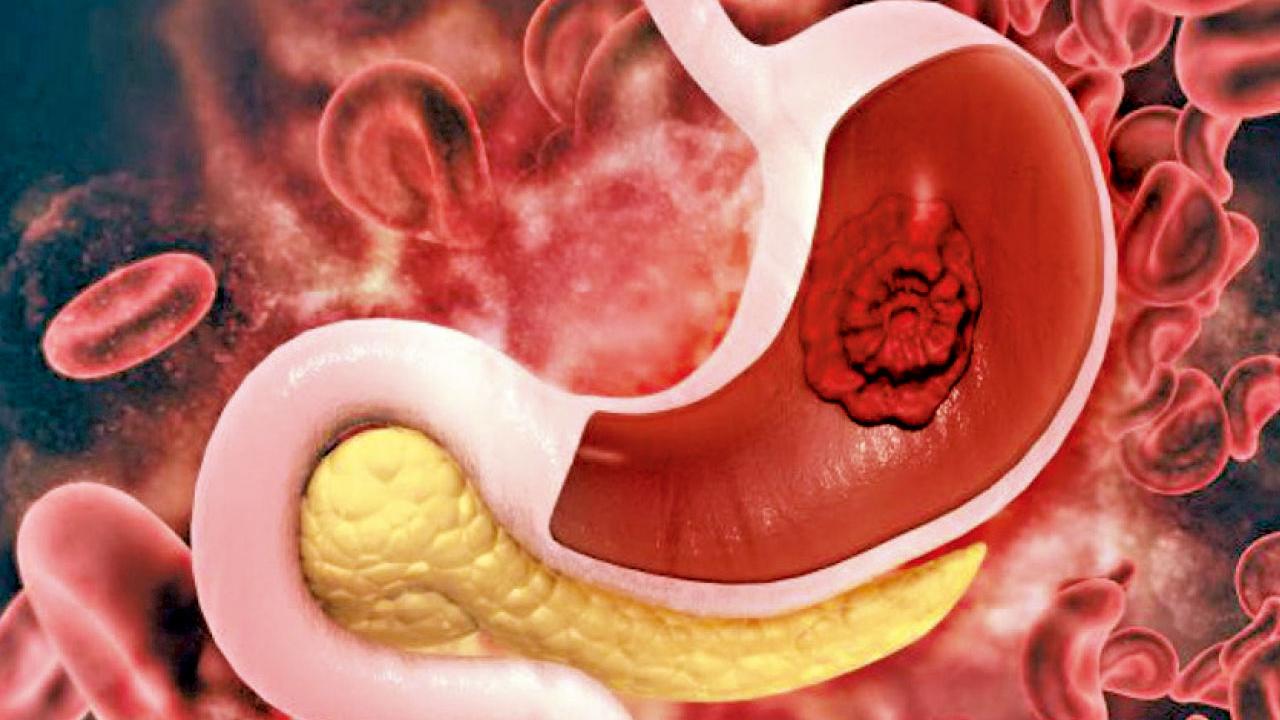 胃腫瘤內窺鏡切除和微創手術