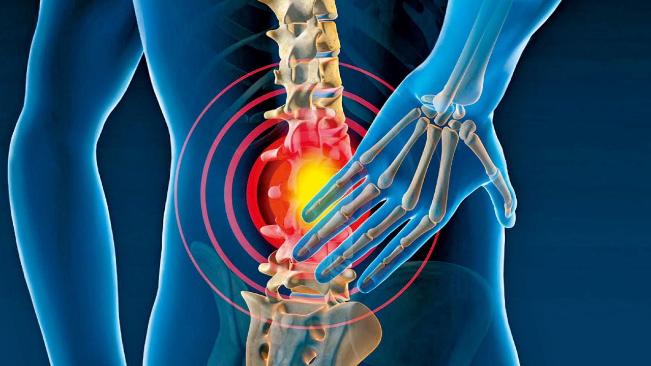 哪種腰椎間盤突出最嚴重？