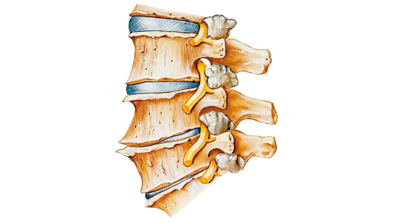 腰椎間盤為何會退化？