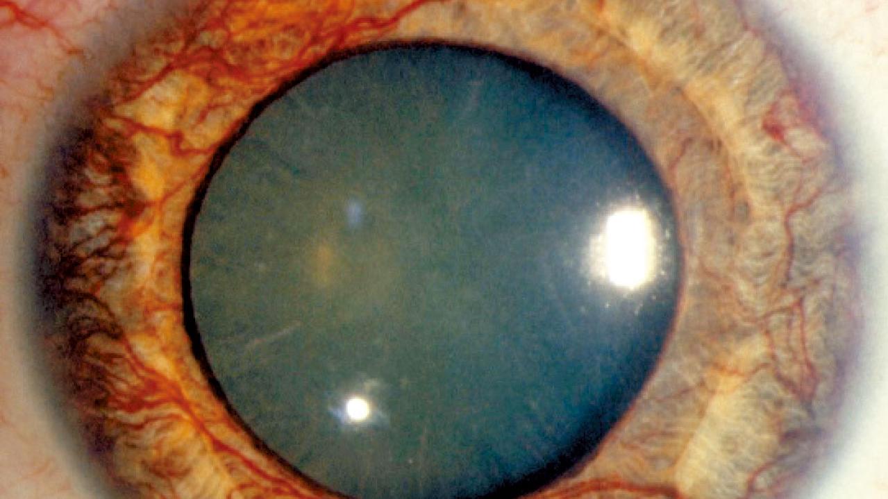 三高與視網膜血管疾病(三)