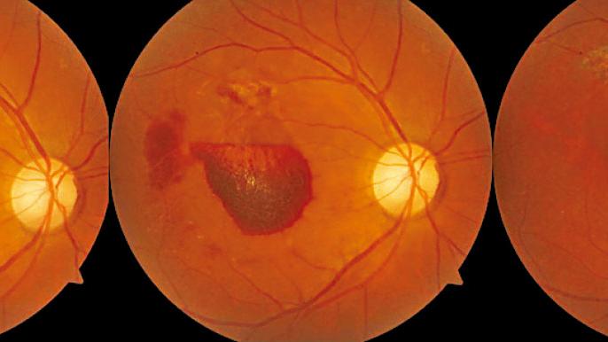 三高與視網膜血管疾病(四)