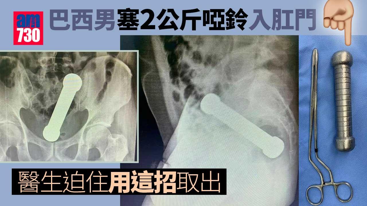 巴西男塞2公斤啞鈴入肛門-醫生迫住用核突招數取出