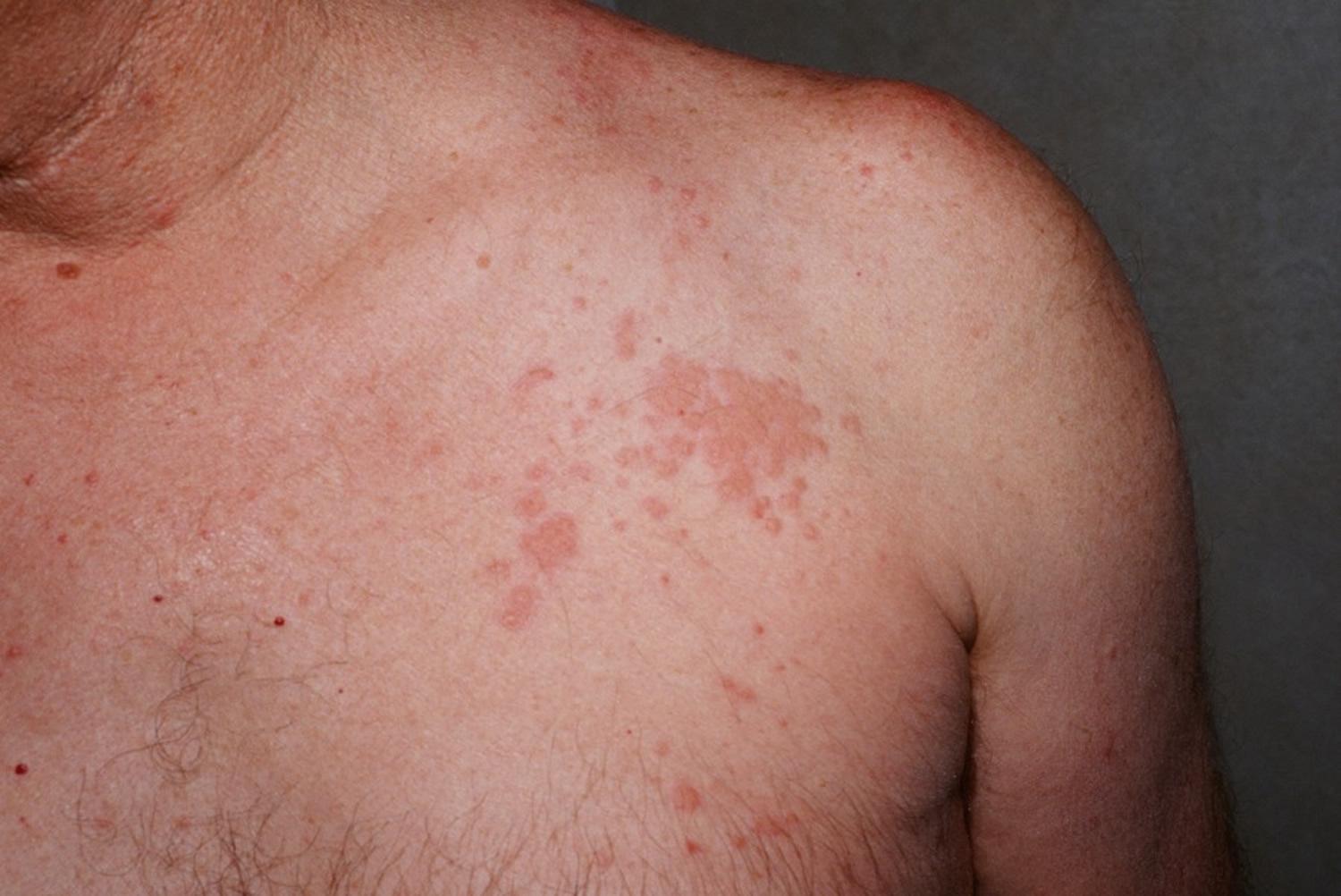 特克斯特綜合症