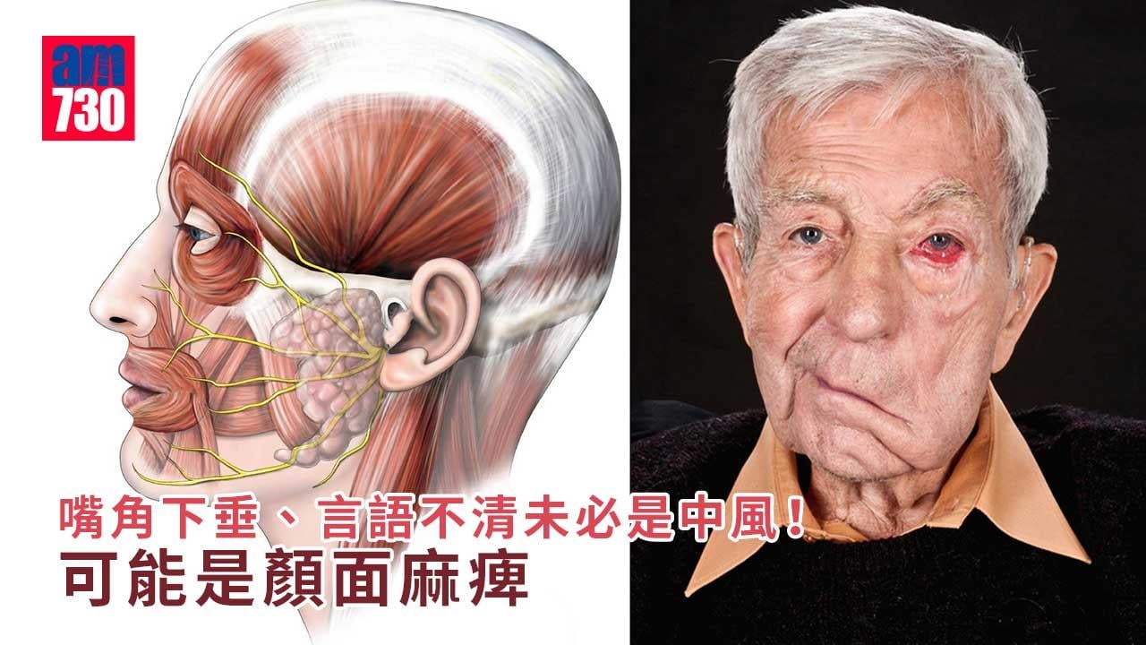顏面麻痺/面癱是中風徵兆？！