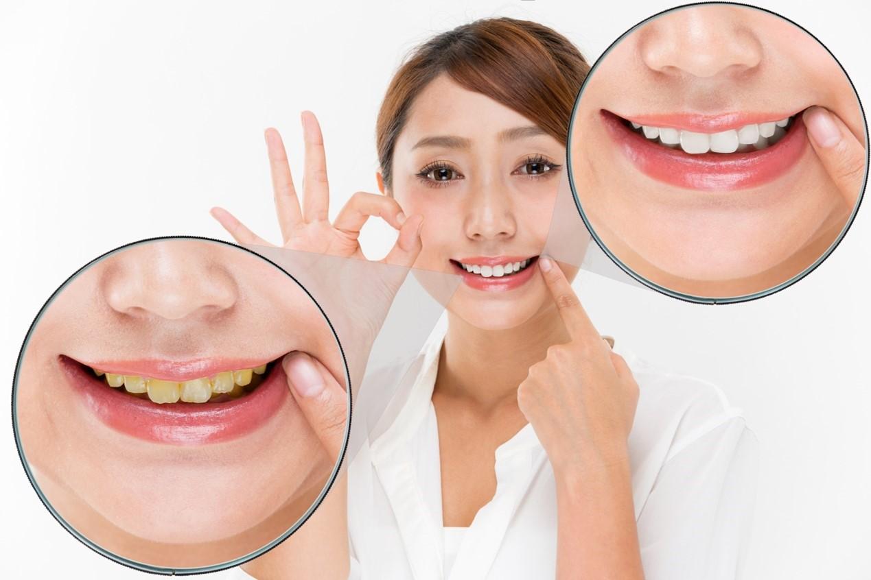 點解啲牙會黃紺紺