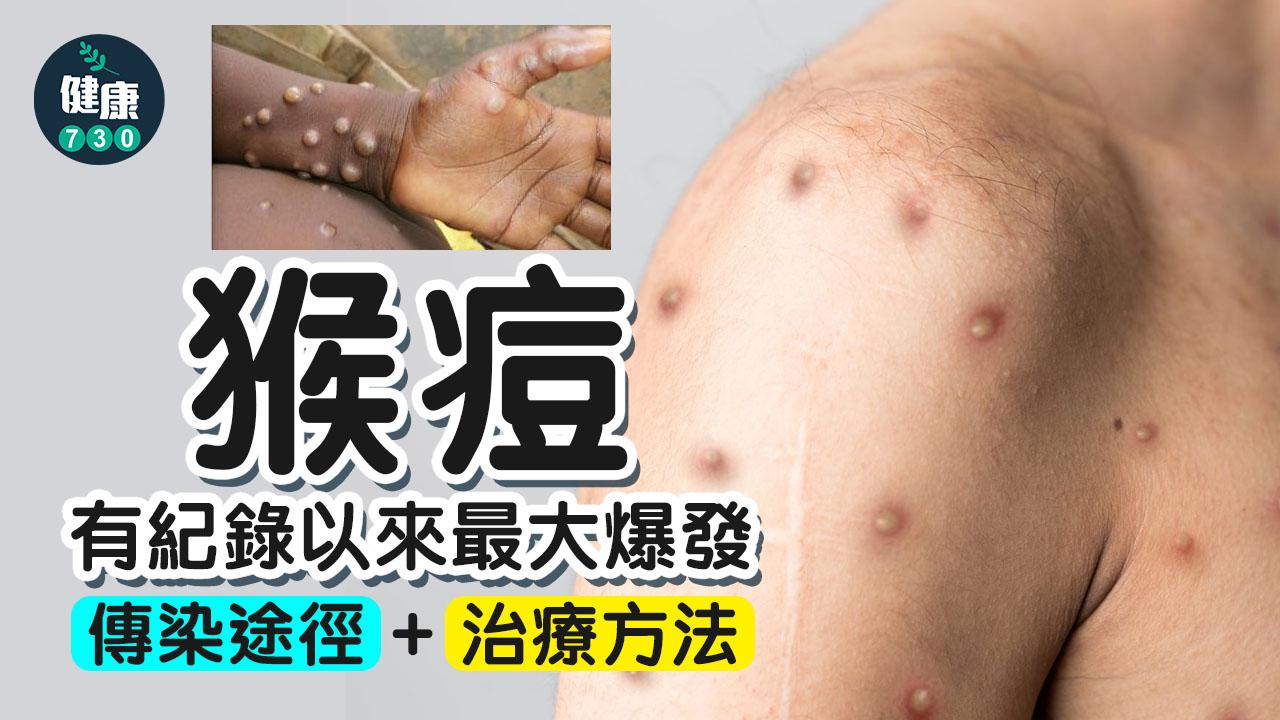 猴痘知多D｜細數起源、確診症狀、傳染途徑及治療方法