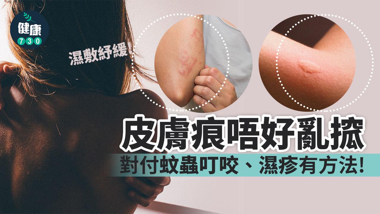 痕唔好亂搲 對付蚊咬、濕疹有方法