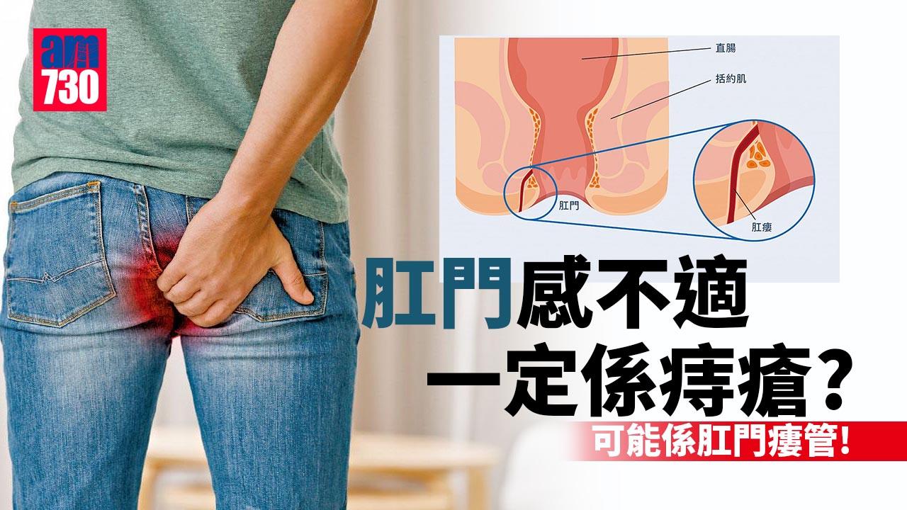 肛門生膿瘡 小心變瘻管