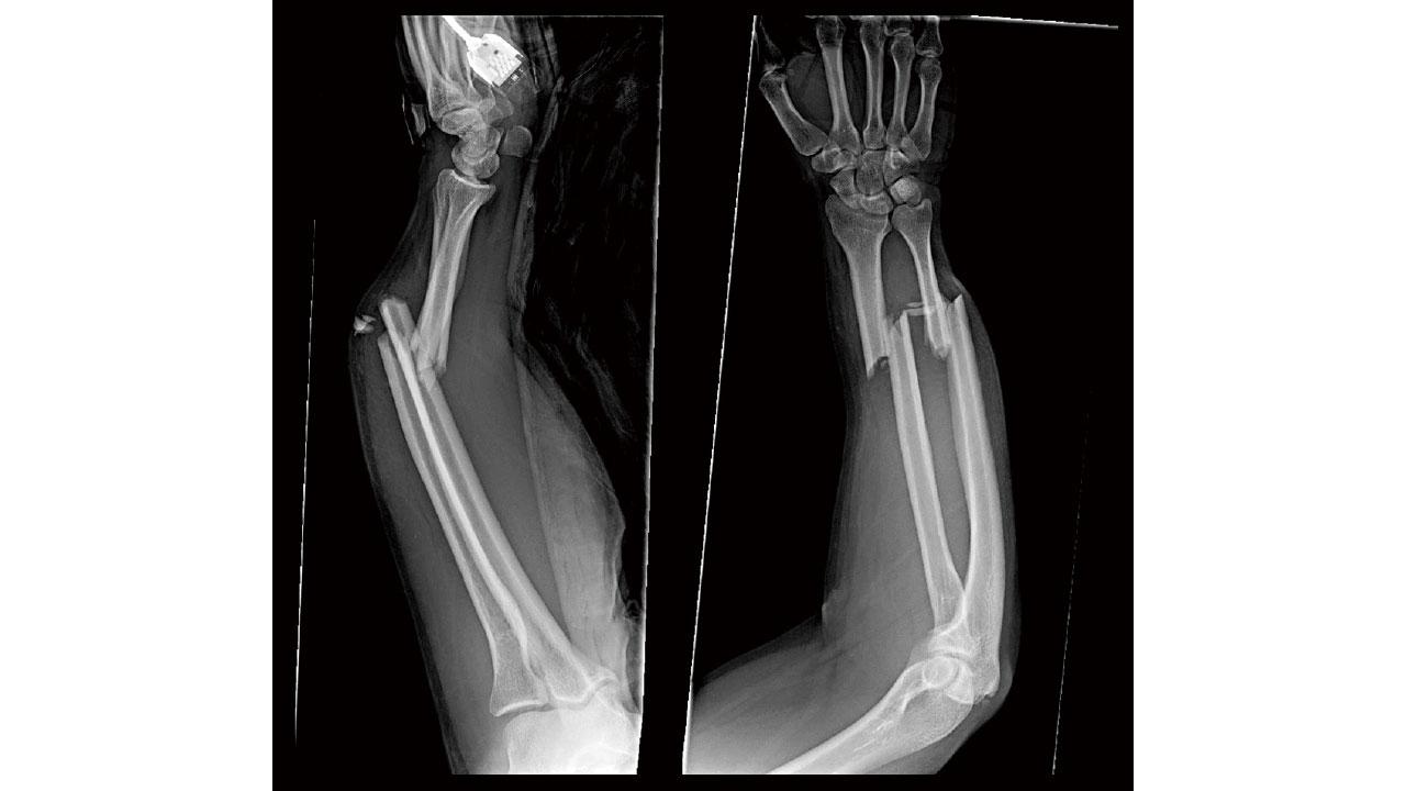 校服的自述： 有種分離叫做前臂骨折