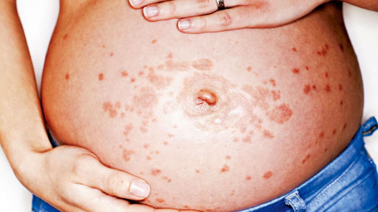 中醫治療懷孕期濕疹