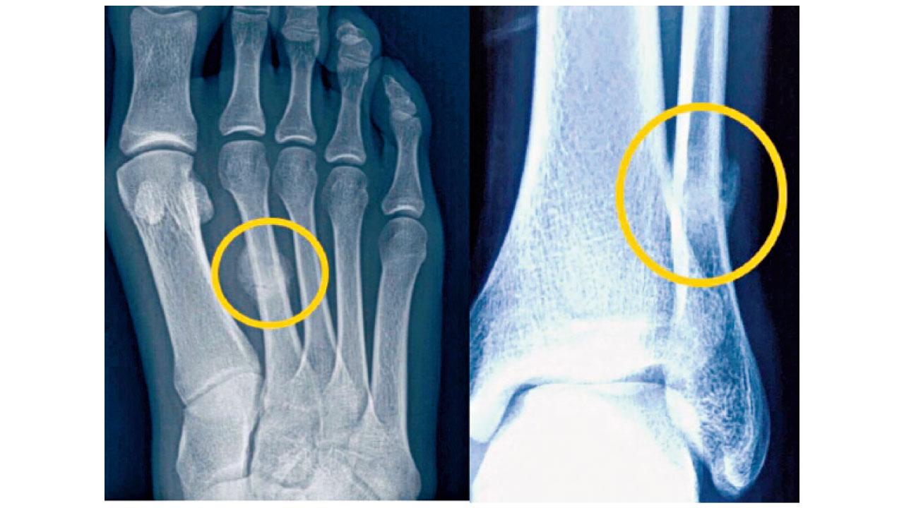 預防疲勞性骨折 休息是為了跑更遠的路