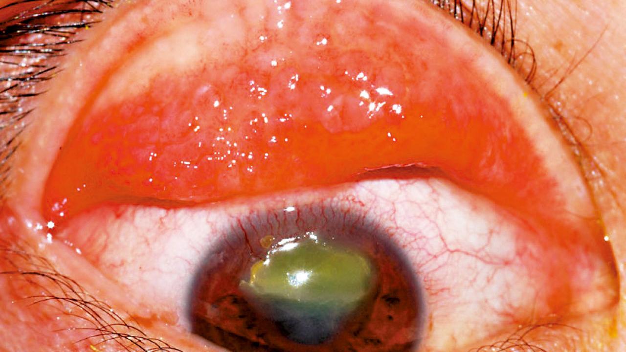 眼痕又眼矇或患春季角膜結膜炎(下)