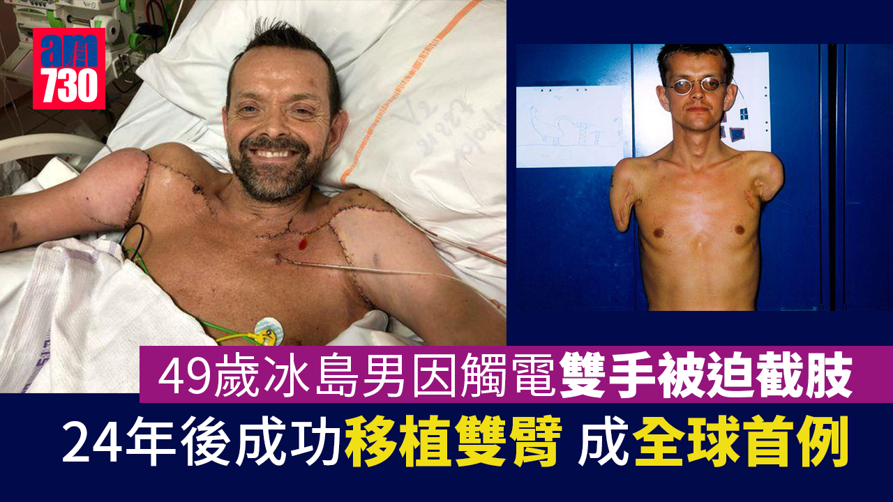 全球首例雙臂移植成功 等了24年終能擁抱女兒