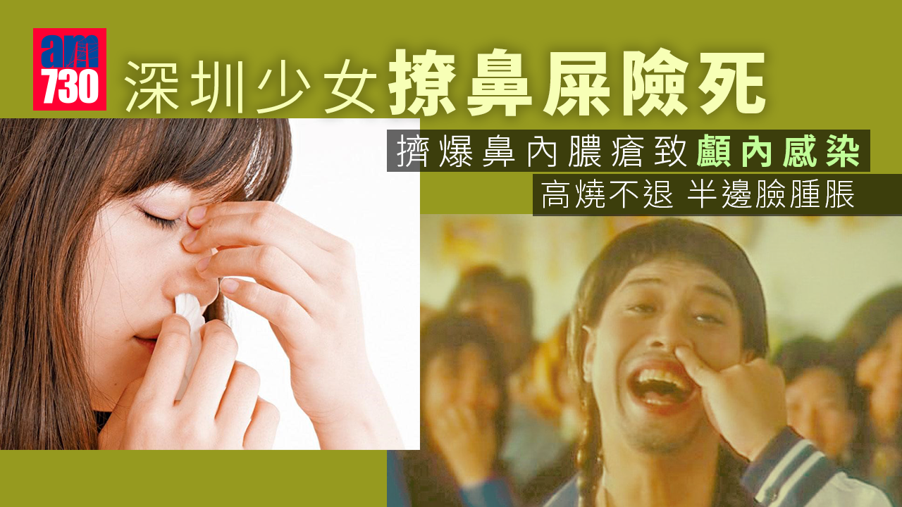 深圳少女愛撩鼻屎 擠爆鼻內膿瘡致顱內感染險死
