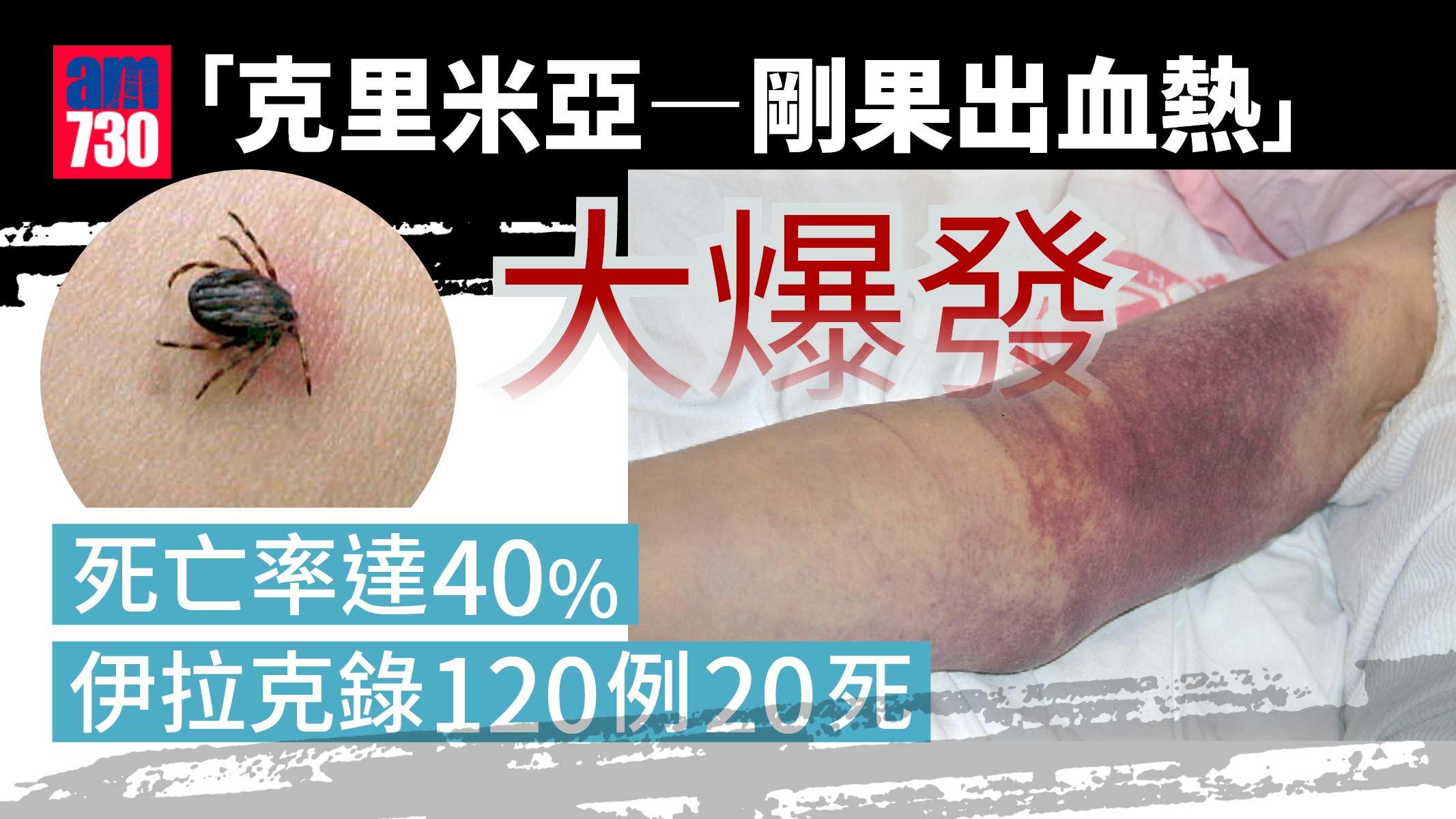 「克里米亞—剛果出血熱」大爆發 死亡率達40% 伊拉克錄120例20死