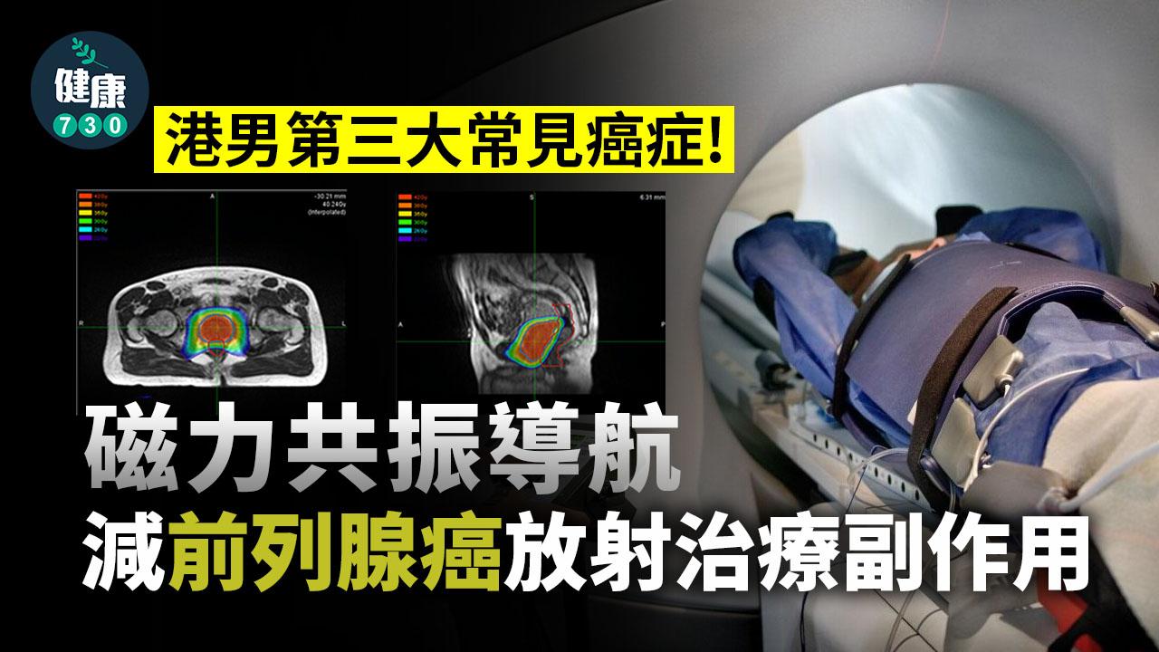 磁力共振導航 減前列腺癌放射治療副作用