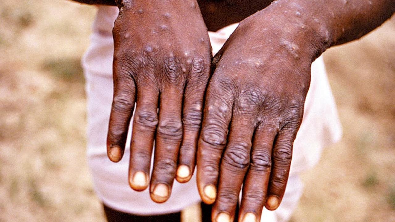 或列「國際關注突發公共衛生事件」 猴痘延39國 世衛召緊急會議