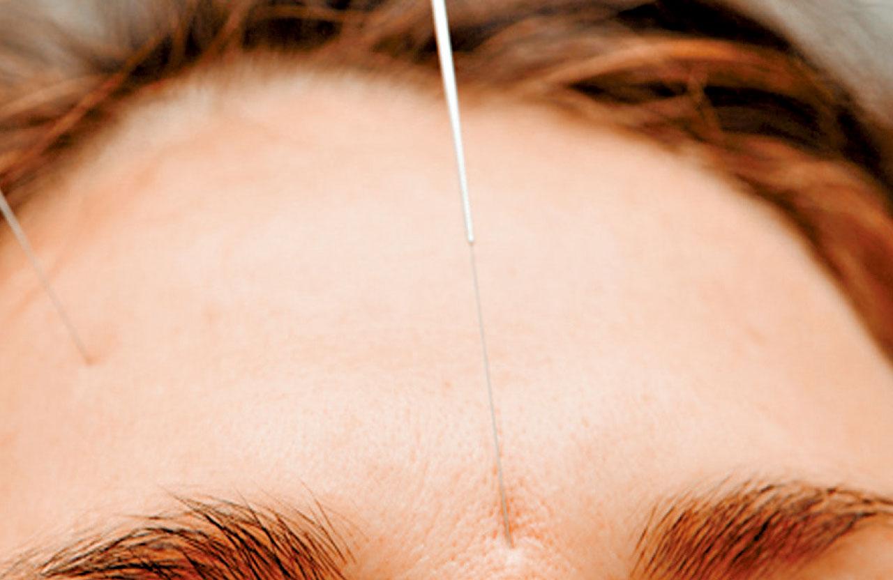針灸治療頭部兩側痛