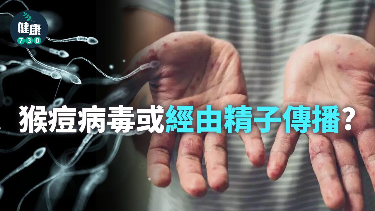 病例持續增加 猴痘病毒或經由精子傳播？