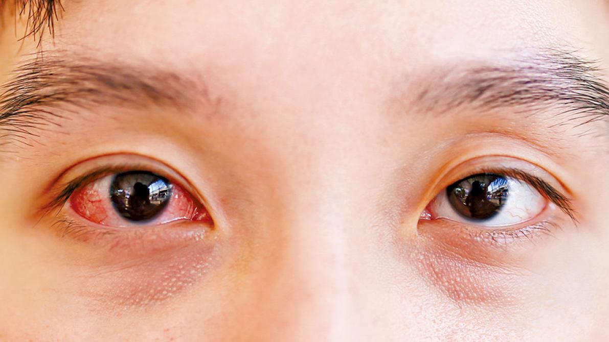 中醫如何處理春季結膜炎？