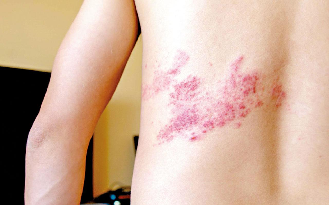 新一代生蛇預防針