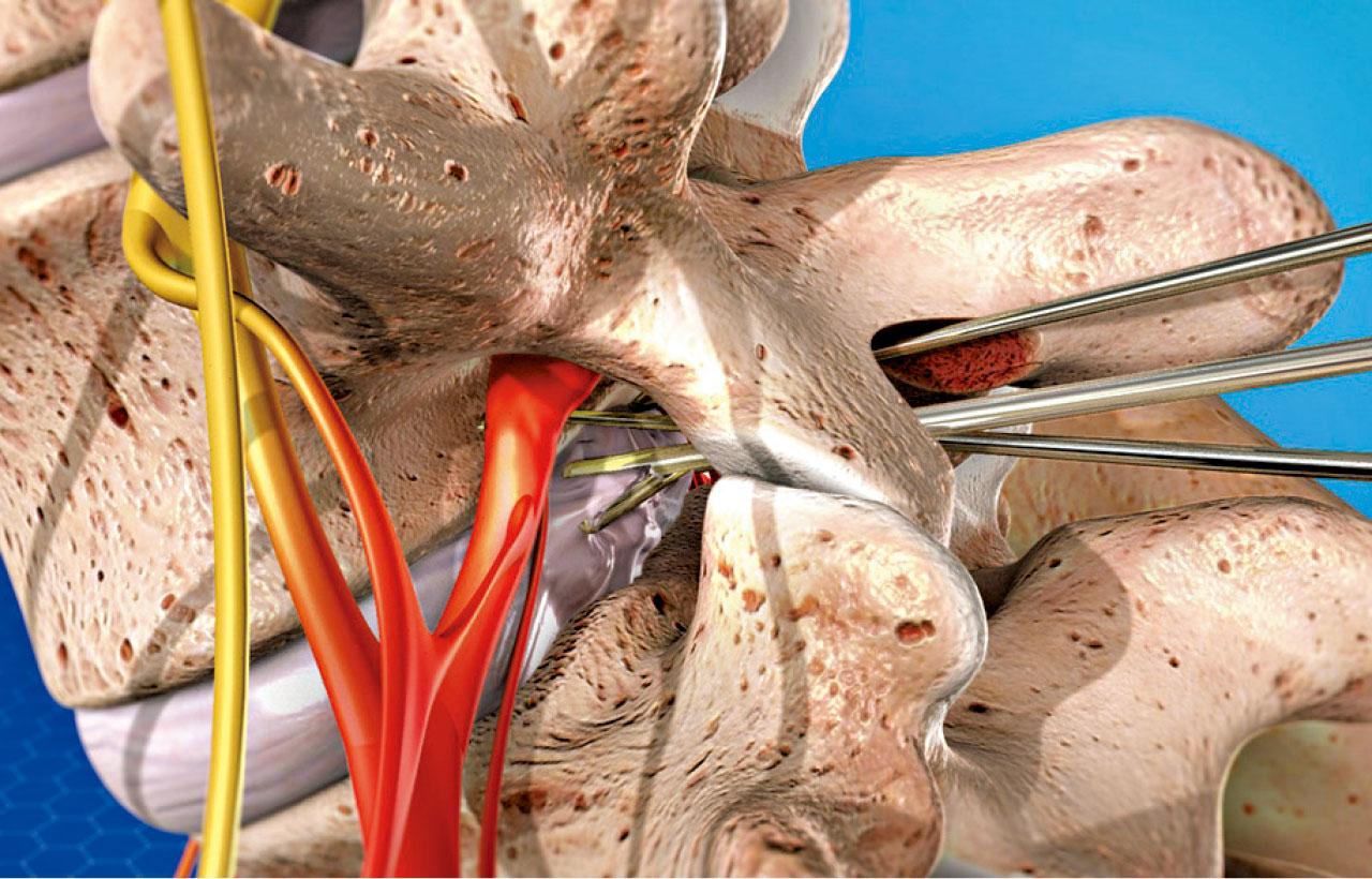 椎間盤突出 何時須開刀？