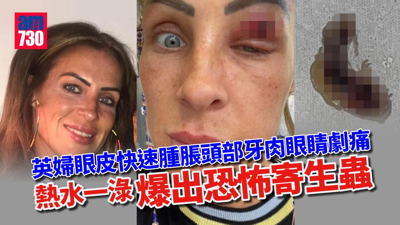 英婦眼皮快速腫脹 連帶頭部牙肉疼痛 熱水一淥即爆出「有腳異形寄生蟲」